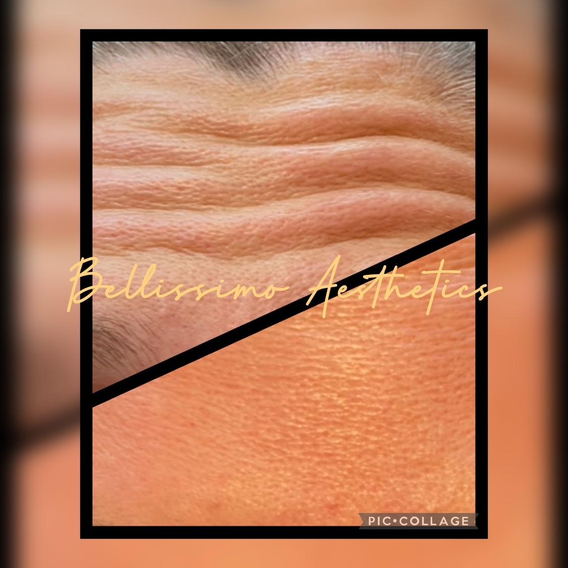 Dermal fillers image 3