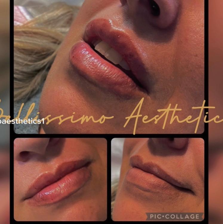 Dermal fillers image 2