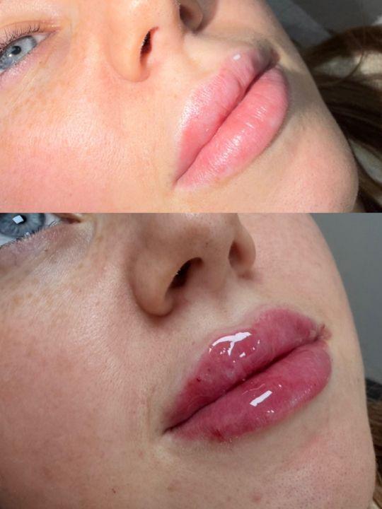 Clinical glow image 2